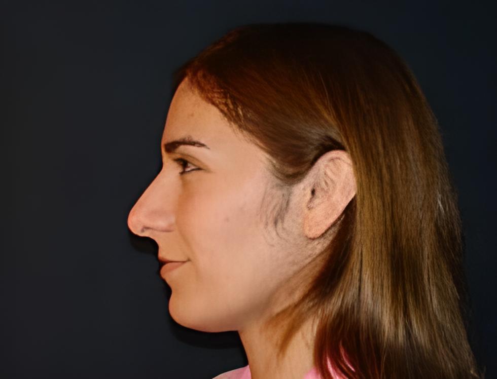 Fotografía de mujer joven antes de la rinoplastía